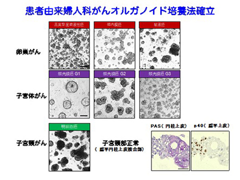 患者由来婦人科がんオルガノイド培養法確立