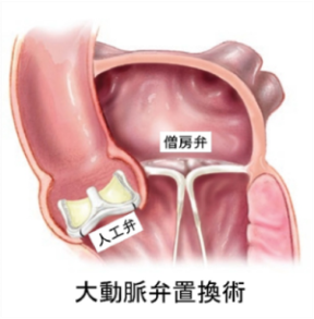 大動脈弁置換術