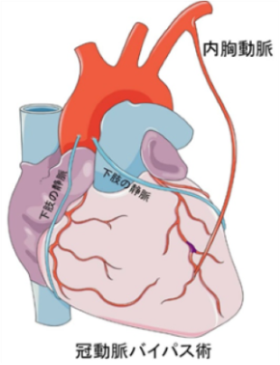 冠動脈バイパス術
