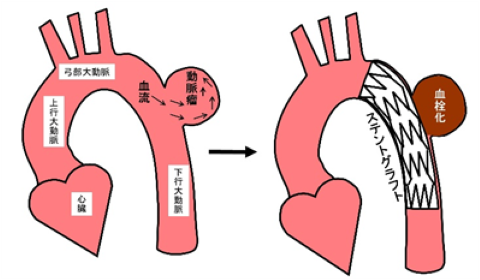 胸部ステント内挿術説明