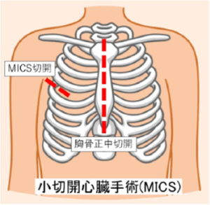 小切開心臓手術