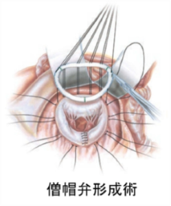 僧帽弁形成術