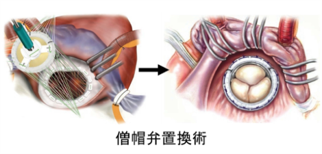 僧帽弁置換術