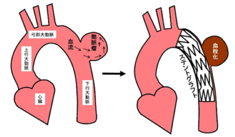 胸部ステントグラフト内挿術説明図