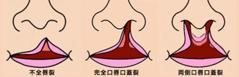 口唇裂イラスト