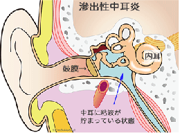 中耳炎 中耳炎
