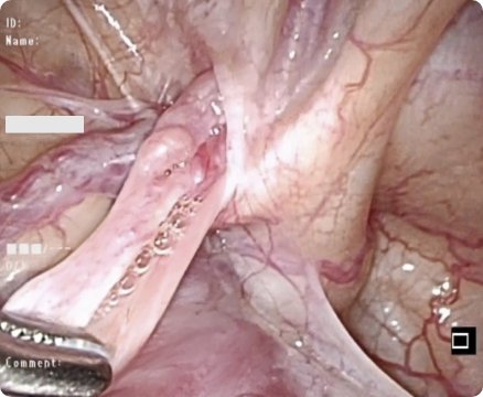 腹腔鏡下鼠経ヘルニア根治術(LPEC)の画像1