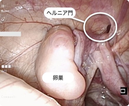 腹腔鏡下鼠経ヘルニア根治術(LPEC)の画像2