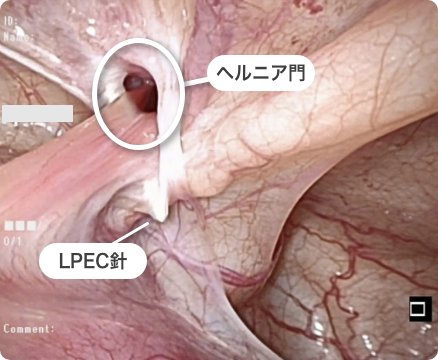 腹腔鏡下鼠経ヘルニア根治術(LPEC)の画像3