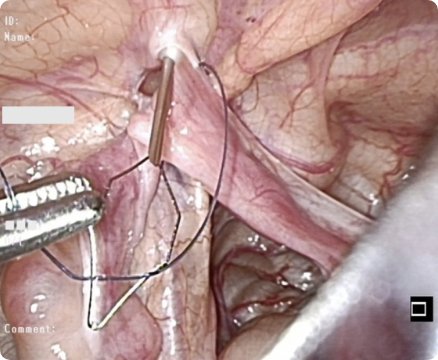 腹腔鏡下鼠経ヘルニア根治術(LPEC)の画像4