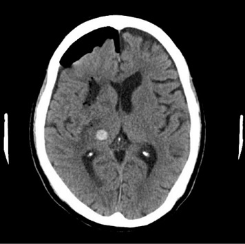 脳内出血の内視鏡手術後の画像