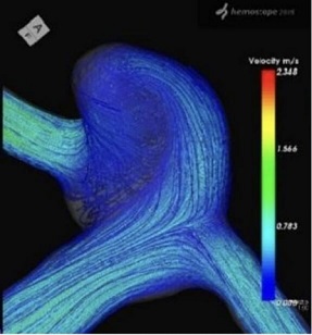 コンピュータによる脳動脈瘤内の血流シミュレーション（CFD）の画像