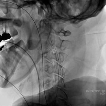 内頸動脈狭窄症に対するステント留置術の画像