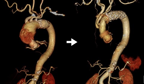 急性A型大動脈解離に対する上行弓部大動脈人工血管置換＋オープンステントグラフト内挿術画像