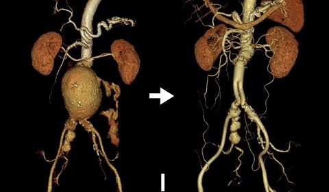 破裂性腹部大動脈瘤に対するY型人工血管置換術画像