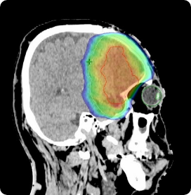 脳腫瘍IMRT画像