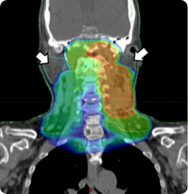 頭頸部IMRT画像