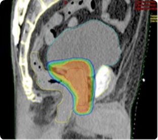 前立腺IMRT画像