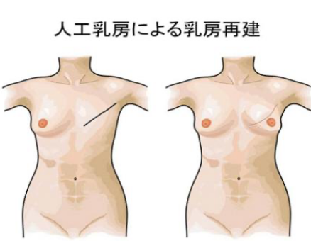 人口乳房による乳房再建