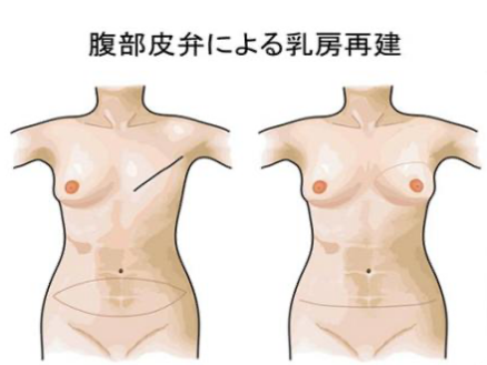 腹部皮弁による乳房再建