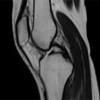 膝関節MRI