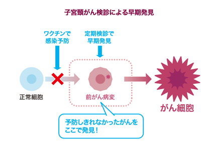 子宮頸がん検診による早期発見