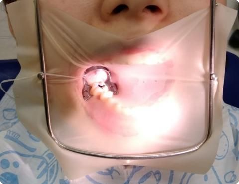 歯科1 ラバーダムの使用写真