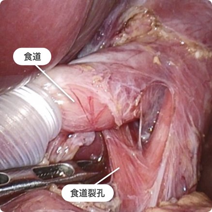 腹腔鏡下Nissen噴門形成術の画像1