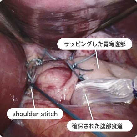 腹腔鏡下Nissen噴門形成術の画像2