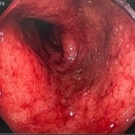手術後 手術後の消化器の写真